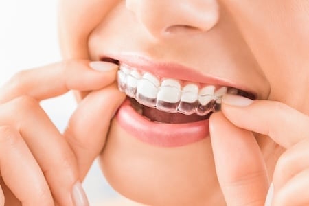Clear aligner treatment