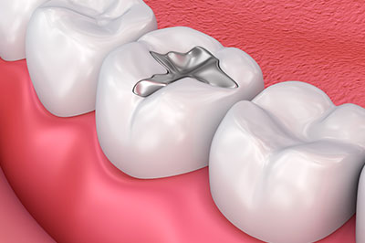 The image displays a dental implant integrated into a tooth structure, set against the backdrop of a human mouth with visible teeth and gums.