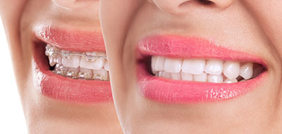 A close-up of a person s smiling face with a focus on their teeth and lips, showcasing dental health care.