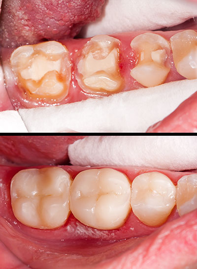 The image displays a close-up view of a person s mouth with teeth that appear to be in poor condition, specifically showing signs of decay and potential dental issues.