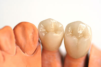 An image of a set of artificial teeth with different shades of tooth enamel, showcasing various options for dental implants.