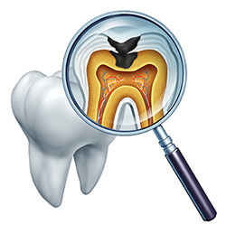 The image shows a magnified view of a tooth with a focus on the pulp chamber, where you can see the root canal and the tooth s nerve.