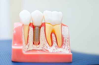 The image shows a model of teeth with various dental implants and a screw, likely used for educational purposes to demonstrate the process of dental implantation.