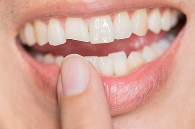 The image shows a close-up of a person s mouth with teeth, holding a finger under their lip as if to emphasize or point out something.