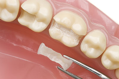 A dental implant in a mouth model with a visible screw, showcasing the process of dental restoration.