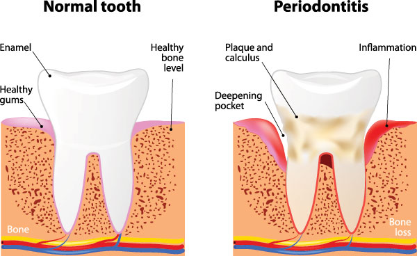 The image is a medical illustration showing the stages of tooth decay progressing from normal to severe, with labels indicating the development of cavities and gum disease.