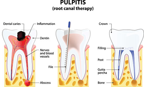 The image is a medical illustration showing the process of pulpitis, where dental caries have reached the inner part of the tooth and are causing inflammation. It includes labeled parts such as the pulp chamber, dentin, nerve endings, and the crown, with annotations explaining each component.