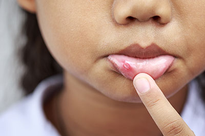 A young child with a noticeable skin blemish, pointing to it with their finger.