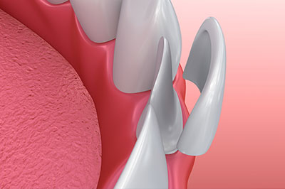 The image shows a close-up of a dental implant with an attached metal abutment, set against a pink background that could represent gum tissue.