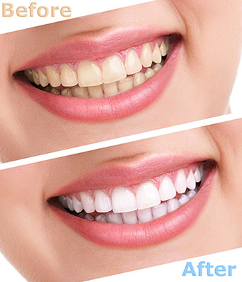 A split-screen image showcasing a person s teeth before and after a dental treatment, highlighting the transformation achieved through the procedure.